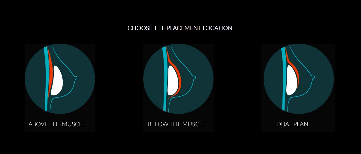 Visual aide for breast implant placement options