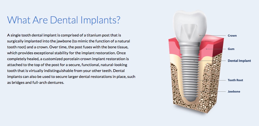 Visual aide for dental implants