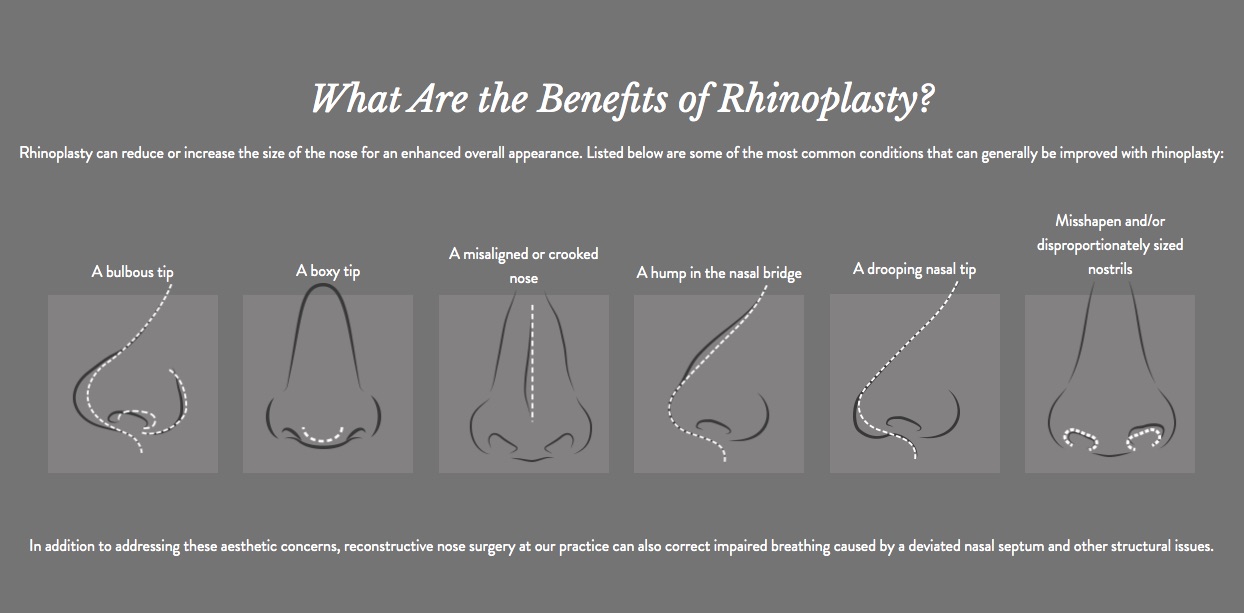Visual aide for rhinoplasty