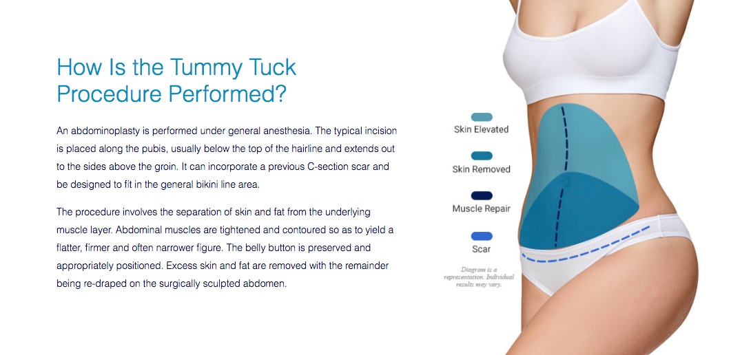 Visual aide for tummy tuck